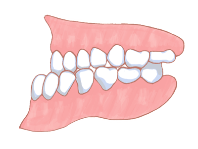 下顎前突（反対咬合・受け口）