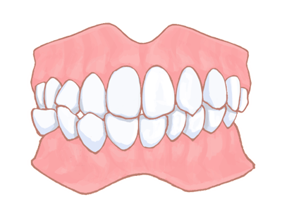 交叉咬合（こうさこうごう）・過蓋咬合（かがいこうごう）
